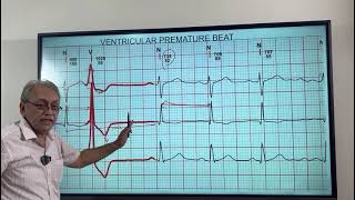 VENTRICULAR ECTOPICS  VENTRICULAR PREMATURE BEATS HOW TO DIAGNOSE ON ECG [upl. by Carrol]