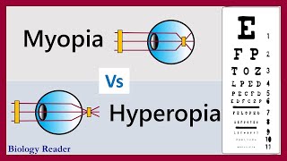 Difference Between Myopia and Hyperopia  Examples and Comparison Chart [upl. by Elise]