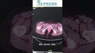 PET scan  How Does a PET Scan Work  Supreme Diagnostic amp Imaging Centre [upl. by Vania]