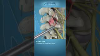 What is Endoscopic Facet Rhizotomy Shorts [upl. by Ahsinev914]