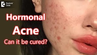 Can Hormonal Acne be cured  Dr Rasya Dixit [upl. by Ahsekahs119]