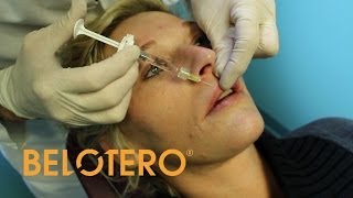 Lip Augmentation with Belotero® Dermal Filler  Louisville KY  Dr Crabtree [upl. by Kilroy]