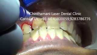 Laser Gum Treatment LANAP in chennai part1 [upl. by Apurk]