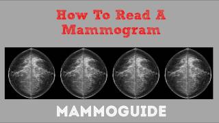 How To Read A Mammogram [upl. by Silbahc]