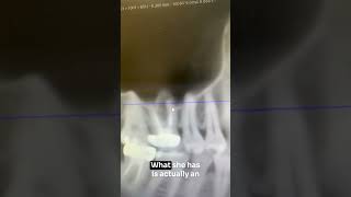 Everytime you chew on an abscessed root canal it spreads infection shorts [upl. by Ahsieni]