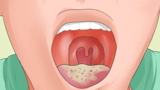 Causas y síntomas de la candidiasis bucal [upl. by Aracat919]