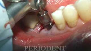 Molar Extraction and Immediate Implant Placement [upl. by Peppy]