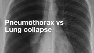 Pneumothorax vs Lung Collapse [upl. by Eittel]