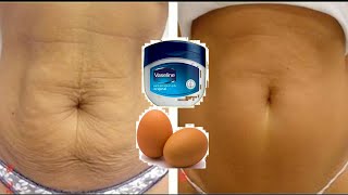 How to get rid of stretch marks and tighten loose belly skin in 5 days with Vaseline Egg and potato [upl. by Anifesoj]