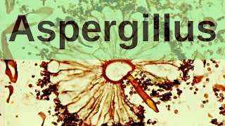 Aspergillus and Aspergillosis  Pathology mini tutorial [upl. by Odnalro563]