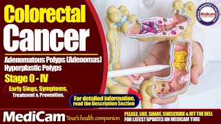 Colorectal Cancer Sings Symptoms And Treatment [upl. by Dlorag]