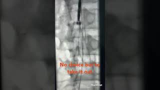 Forceps removal of a problematic IVC filter causing extensive iliocaval thrombosis [upl. by Lanod910]