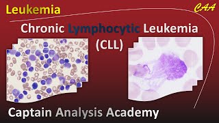 E4 Chronic Lymphoblastic Leukemia CLL سرطان الدم الليمفاوي المزمن [upl. by Acemat]