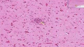 Histopathology Brain Viral encephalitis [upl. by Nevaeh]