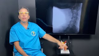 Spasmodic torticollis  cervical dystonia  treatment with prolotherapy  Ross Hauser MD [upl. by Heyra]