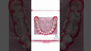 ORTHODONTIC SPACE CLOSURE  ORTHODONTIC TIPS Shorts [upl. by Verger]