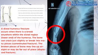 COMMINUTED FRACTURE DISTAL FOURTH HUMERUS [upl. by Lyrehs233]