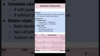 Ventricular Tachycardia [upl. by Atekin577]