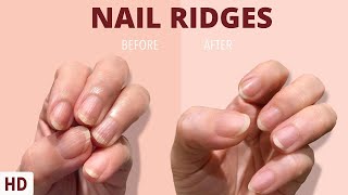 Nail Ridges The Silent Signaling Your Nails Are Trying to Tell You [upl. by Aicinat]