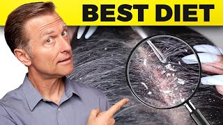 How to Get Rid of Dandruff Once and for All [upl. by Nodyarg]