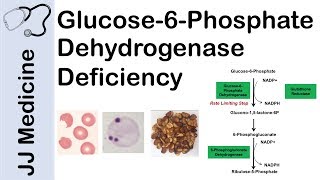 Glucose6Phosphate Dehydrogenase Deficiency  Symptoms Pathophysiology Diagnosis and Treatment [upl. by Lynna]