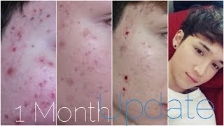 KOREAN FRAXEL LASER EXPERIENCE 1 MONTH UPDATE  mrpanda101 [upl. by Haggerty]