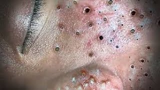 Toltal Best blackheads by Loan Nguyen No ads [upl. by Gamaliel843]