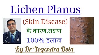 Lichen Planus  Skin Disease  के कारण लक्षण और 100 इलाज  By Dr Yogendra Bola [upl. by Donoho]