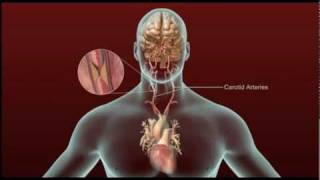 Stroke  Carotid Artery Disease and TIA [upl. by Tyra]