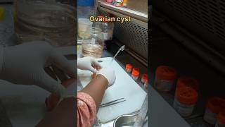 Ovarian cyst specimen  கருமுட்டை நீர்க்கட்டி [upl. by Otila411]