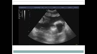 CASE 6 purulent peritonitis due to perforated appendicitis [upl. by Rudie872]