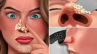 ASMR Satisfying Full Blackhead and Secretions Removal Treatment  Skincare animation [upl. by Ejroj]