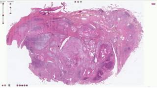 Hashimoto Thyroiditis  Histopathology [upl. by Akira345]