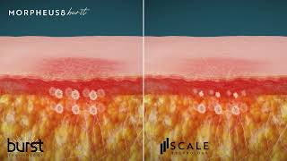 Morpheus8 Burst amp Scale [upl. by Aneda]