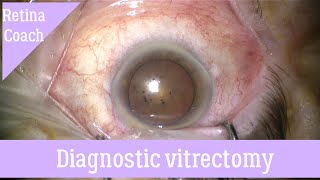 Diagnostic vitrectomy [upl. by Aititil]