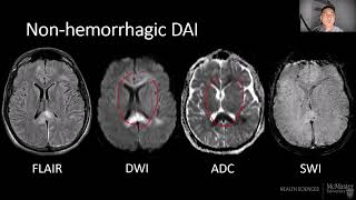 Traumatic Brain Injury  Dr Euan Zhang [upl. by Atiuqet699]