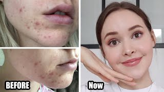 How To Really Get Rid Of Acne amp textureacne scarsskin damage Adult Hormonal Acne [upl. by Island]