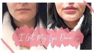 I GOT LIP FILLERS  Getting 1ml of Juvederm Volift  beckyloubutton [upl. by Amieva]