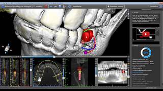 Come realizzare una dima chirurgica con il software gratuito Blue Sky Plan [upl. by Olwena]