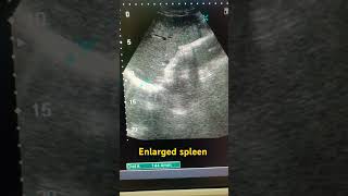 Spleen siz splenomegaly ultrasound ytviral medical study spleen shortfeed shortviral abdomen [upl. by Flory931]