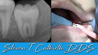 Extracting Maxillary amp Mandibular Wisdom Teeth  Dental Minute with Steven T Cutbirth DDS [upl. by Bardo]