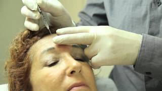 Injections de Botox ou toxine botulique  Technique et résultats [upl. by Yrocal]