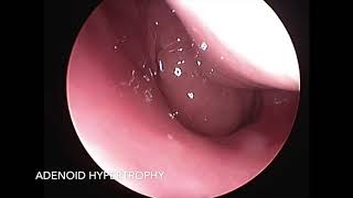 Adenoid Hypertrophy  Diagnostic Nasal Endoscopy [upl. by Dustie861]