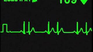 Nodal Bigeminy  ECG Simulator  Arrhythmia Simulator [upl. by Hilar]