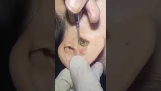 Ear Blackheads  Blackheads in Ear  Ear Blackheads This Week  Ear Cleaning [upl. by Demmahum34]