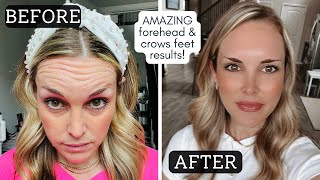 Botox Before amp After  Forehead Wrinkles amp Crows Feet  10 Day Progression [upl. by Casey]