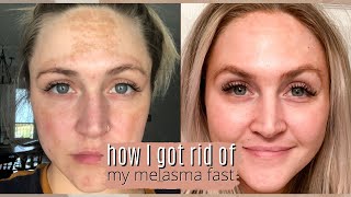 MUSELY SPOT CREAM  HOW I GOT RID OF MY MELASMA FAST WITH MUSELY  Ashley Keene [upl. by Sabian]