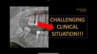 How to solve this clinical case OPG interpretation radiology radiographic interpretation x ray [upl. by Onitsoga]