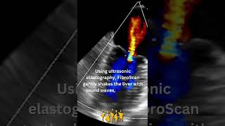 Meet the FibroScan [upl. by Doughty999]