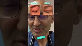 JOURNEY OF BLEPHAROPLASTY  DR TANVEER JANJUA NEW JERSEY [upl. by Erlin164]